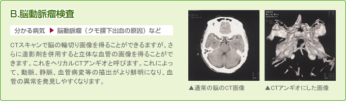 CTアンギオでみる脳腫瘍検査(血管異常の発見)