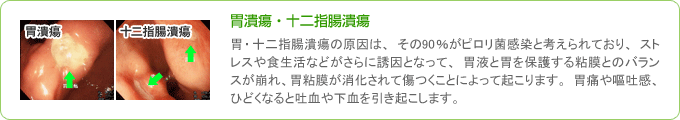 ピロリ菌による胃潰瘍・十二指腸潰瘍