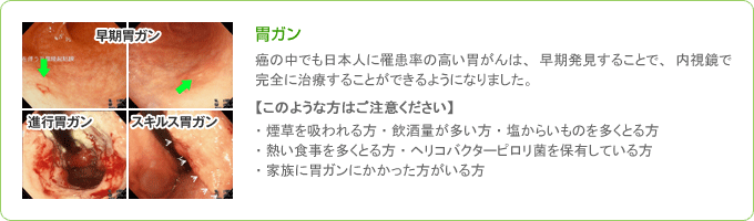 日本人に最も多い胃がん