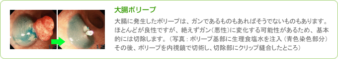 大腸ポリープを内視鏡で切除