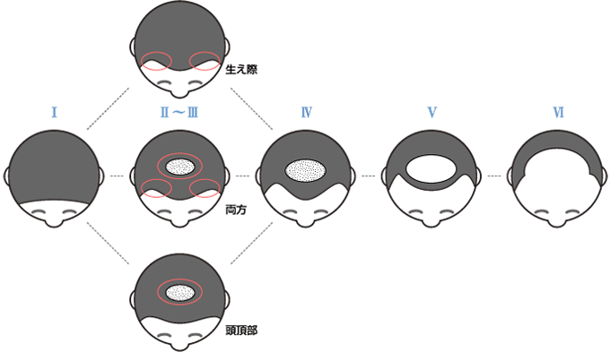 AGA薄毛の進行図